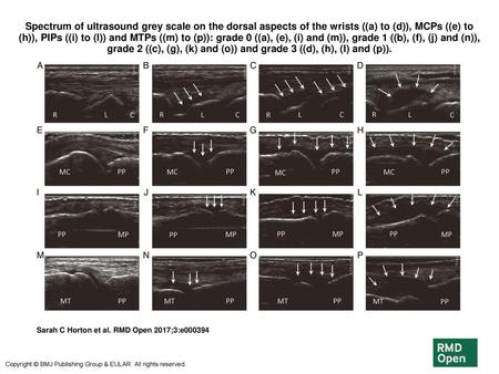 Spectrum of ultrasound grey scale on the dorsal aspects of the wrists ((a) to (d)), MCPs ((e) to (h)), PIPs ((i) to (l)) and MTPs ((m) to (p)): grade 0.