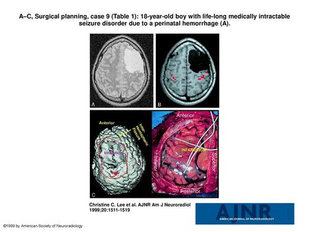 A–C, Surgical planning, case 9 (Table 1): 18-year-old boy with life-long medically intractable seizure disorder due to a perinatal hemorrhage (A). A–C,