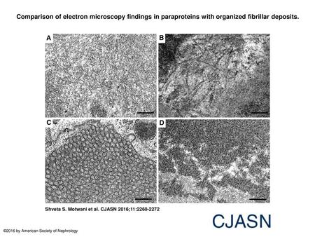 Comparison of electron microscopy findings in paraproteins with organized fibrillar deposits. Comparison of electron microscopy findings in paraproteins.