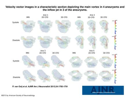 Velocity vector images in a characteristic section depicting the main vortex in 4 aneurysms and the inflow jet in 3 of the aneurysms. Velocity vector images.