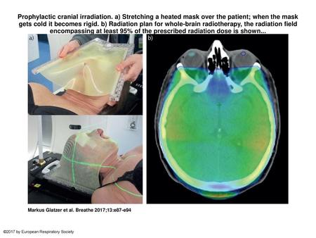 Prophylactic cranial irradiation