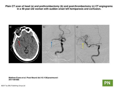 Plain CT scan of head (a) and prethrombectomy (b) and post-thrombectomy (c) CT angiograms in a 49-year-old woman with sudden onset left hemiparesis and.