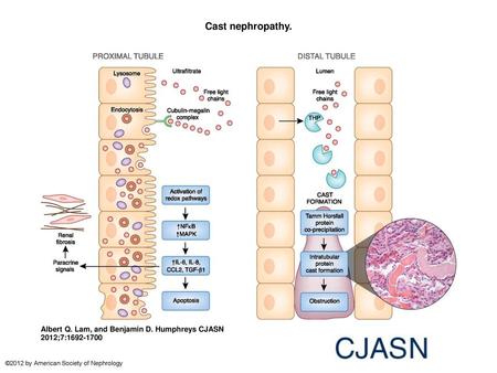 Cast nephropathy. Cast nephropathy. Schematic diagram illustrating the pathophysiology of AKI in cast nephropathy. Free light chains filtered by the glomerulus.