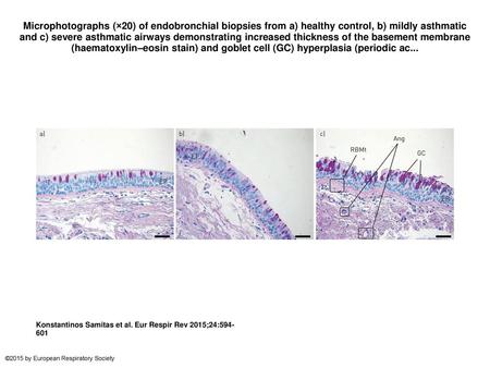 Microphotographs (×20) of endobronchial biopsies from a) healthy control, b) mildly asthmatic and c) severe asthmatic airways demonstrating increased thickness.