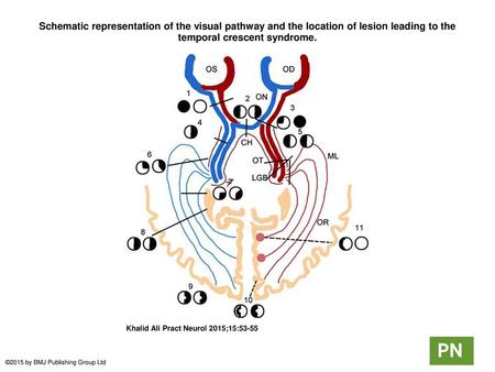 Schematic representation of the visual pathway and the location of lesion leading to the temporal crescent syndrome. Schematic representation of the visual.