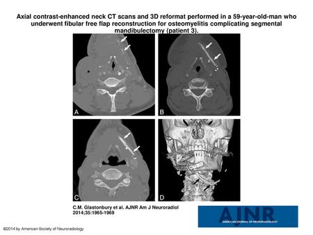 Axial contrast-enhanced neck CT scans and 3D reformat performed in a 59-year-old-man who underwent fibular free flap reconstruction for osteomyelitis complicating.