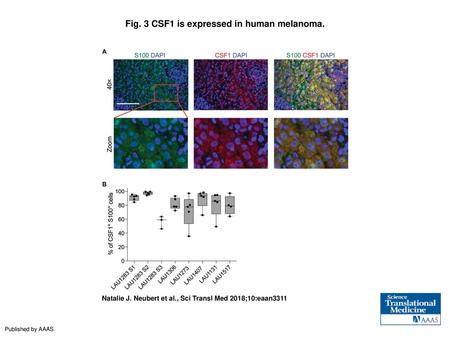 Fig. 3 CSF1 is expressed in human melanoma.