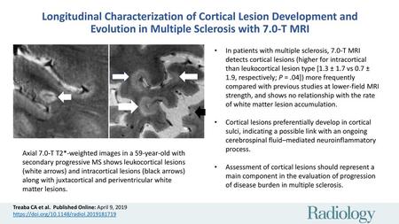 Longitudinal Characterization of Cortical Lesion Development and Evolution in Multiple Sclerosis with 7.0-T MRI In patients with multiple sclerosis, 7.0-T.