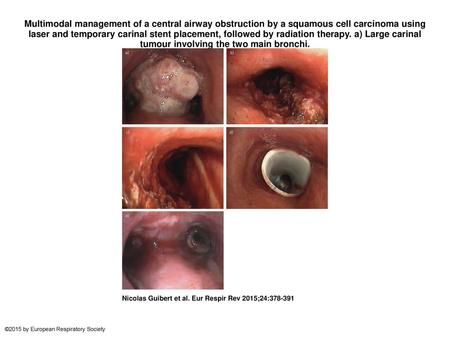 Multimodal management of a central airway obstruction by a squamous cell carcinoma using laser and temporary carinal stent placement, followed by radiation.