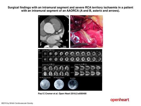 Surgical findings with an intramural segment and severe RCA territory ischaemia in a patient with an intramural segment of an AAORCA (A and B, asterix.