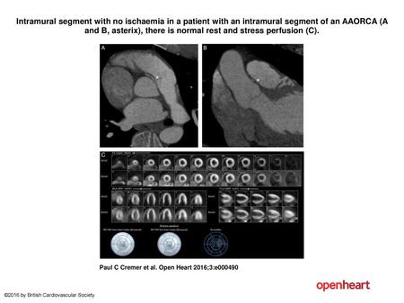 Intramural segment with no ischaemia in a patient with an intramural segment of an AAORCA (A and B, asterix), there is normal rest and stress perfusion.