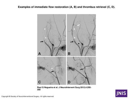 Examples of immediate flow restoration (A, B) and thrombus retrieval (C, D). Examples of immediate flow restoration (A, B) and thrombus retrieval (C, D).