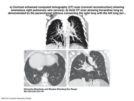 A) Contrast enhanced computed tomography (CT) scan (coronal reconstruction) showing anomalous right pulmonary vein (arrows). b) Axial CT scan showing horseshoe.