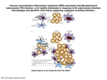 Immune reconstitution inflammatory syndrome (IRIS) associated with Mycobacterium tuberculosis (TB) infection. a) In healthy individuals in response to.