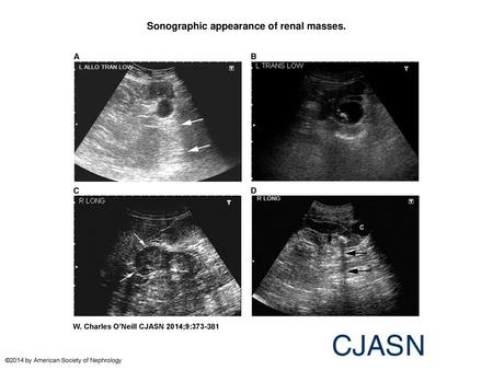 Sonographic appearance of renal masses.