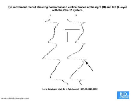 Eye movement record showing horizontal and vertical traces of the right (R) and left (L) eyes with the Ober-2 system. Eye movement record showing horizontal.