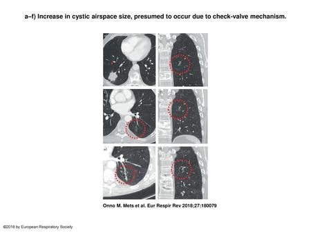 A–f) Increase in cystic airspace size, presumed to occur due to check-valve mechanism. a–f) Increase in cystic airspace size, presumed to occur due to.