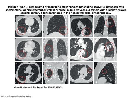 Multiple (type 3) cyst-related primary lung malignancies presenting as cystic airspaces with asymmetrical or circumferential wall thickening. a, b) A 52-year-old.