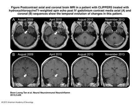 Figure Postcontrast axial and coronal brain MRI in a patient with CLIPPERS treated with hydroxychloroquineT1-weighted spin echo post IV gadolinium contrast.