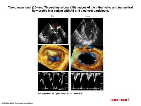 Two-dimensional (2D) and Three-dimensional (3D) images of the mitral valve and transmitral flow profile in a patient with AS and a control participant.