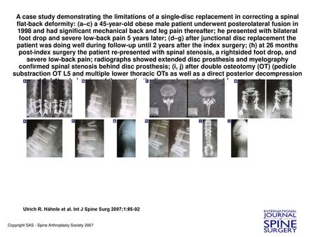 A case study demonstrating the limitations of a single-disc replacement in correcting a spinal flat-back deformity: (a–c) a 45-year-old obese male patient.