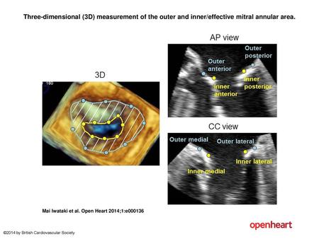 Three-dimensional (3D) measurement of the outer and inner/effective mitral annular area. Three-dimensional (3D) measurement of the outer and inner/effective.