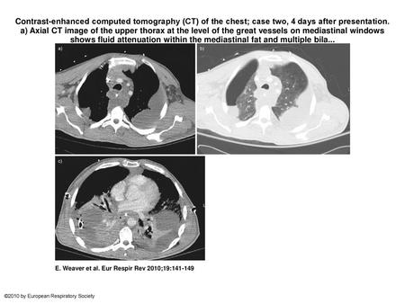 Contrast-enhanced computed tomography (CT) of the chest; case two, 4 days after presentation. a) Axial CT image of the upper thorax at the level of the.