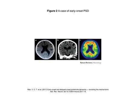 Figure 2 A case of early-onset PSD