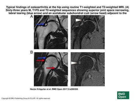 Typical findings of osteoarthritis at the hip using routine T1-weighted and T2-weighted MRI. (A) Sixty-three years M, T1FS and T2-weighted sequences showing.