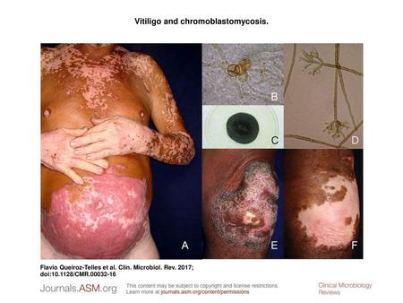 Vitiligo and chromoblastomycosis.