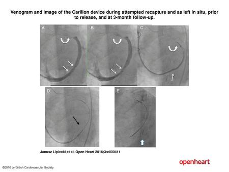 Venogram and image of the Carillon device during attempted recapture and as left in situ, prior to release, and at 3-month follow-up. Venogram and image.