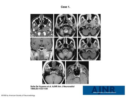 Case 1. Case 1. A, Unenhanced axial CT scan through the nasopharyngeal region shows thickening of the nasopharyngeal tissues at the level of the left torus.