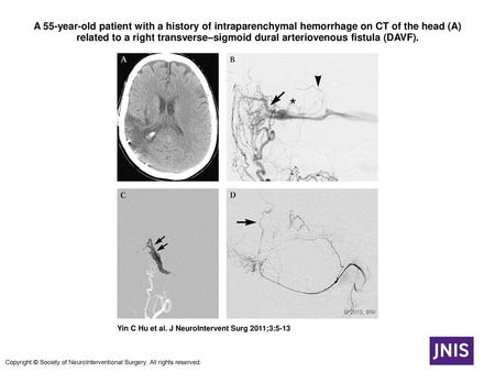 A 55-year-old patient with a history of intraparenchymal hemorrhage on CT of the head (A) related to a right transverse–sigmoid dural arteriovenous fistula.