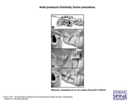 Axial presacral interbody fusion procedure.