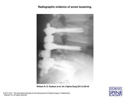 Radiographic evidence of screw loosening.