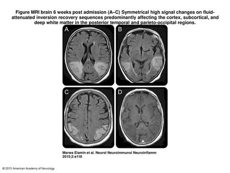 Figure MRI brain 6 weeks post admission (A–C) Symmetrical high signal changes on fluid-attenuated inversion recovery sequences predominantly affecting.