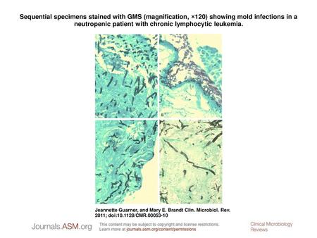 Sequential specimens stained with GMS (magnification, ×120) showing mold infections in a neutropenic patient with chronic lymphocytic leukemia. Sequential.