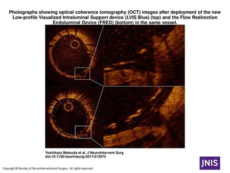 Photographs showing optical coherence tomography (OCT) images after deployment of the new Low-profile Visualized Intraluminal Support device (LVIS Blue)