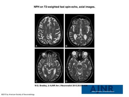 NPH on T2-weighted fast spin-echo, axial images.