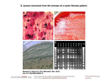 S. aureus recovered from the airways of a cystic fibrosis patient.