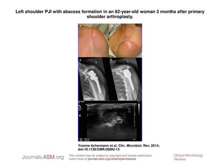 Left shoulder PJI with abscess formation in an 82-year-old woman 3 months after primary shoulder arthroplasty. Left shoulder PJI with abscess formation.