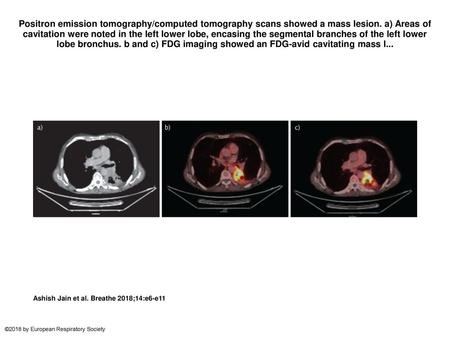 Positron emission tomography/computed tomography scans showed a mass lesion. a) Areas of cavitation were noted in the left lower lobe, encasing the segmental.