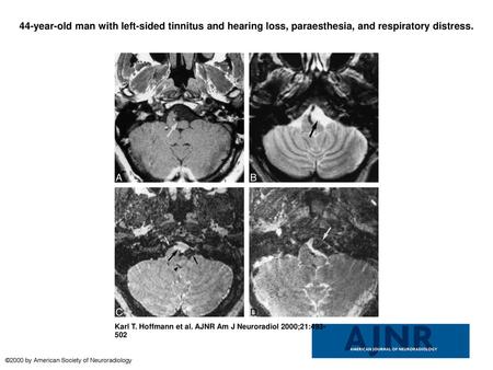 44-year-old man with left-sided tinnitus and hearing loss, paraesthesia, and respiratory distress. 44-year-old man with left-sided tinnitus and hearing.