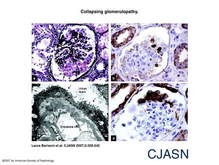 Collapsing glomerulopathy.