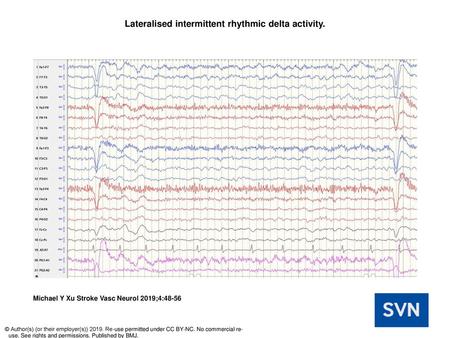 Lateralised intermittent rhythmic delta activity.