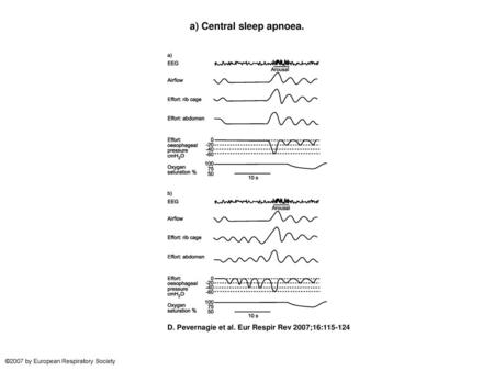 a) Central sleep apnoea.