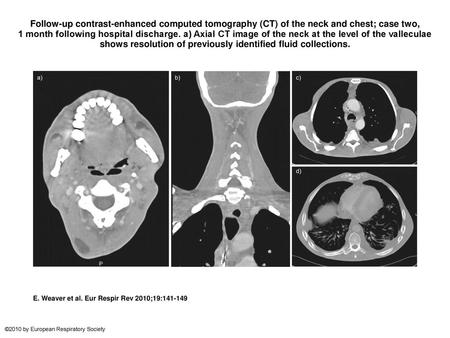 Follow-up contrast-enhanced computed tomography (CT) of the neck and chest; case two, 1 month following hospital discharge. a) Axial CT image of the neck.