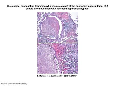 Histological examination (Haematoxylin-eosin staining) of the pulmonary aspergilloma. a) A dilated bronchus filled with necrosed aspergillus hyphae. Histological.