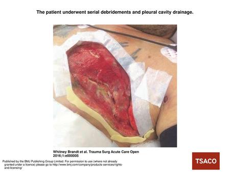 The patient underwent serial debridements and pleural cavity drainage.