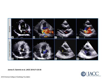 James S. Gammie et al. JACC 2018;71:25-36